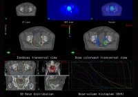Composite image showing PET/CT fusion scans, isodose mapping, and dose-volume histograms used in radiation therapy planning and oncology diagnostics. 