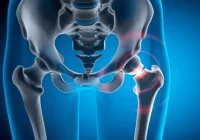 3D illustration of the hip joint with a pain highlight, representing orthopaedics, arthritis and joint health.