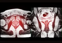Prostate MRI images with highlighted prostate gland, illustrating cross-sectional soft-tissue imaging used in diagnostic radiology and clinical assessment.