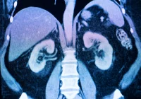 Abdominal CT scan showing both kidneys, illustrating medical imaging for renal anatomy, kidney disease assessment and diagnostic radiology.