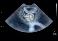 Ultrasound image showing a prostate examination view.