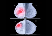 Breast mammography imaging showing suspicious lesion highlighted for early cancer detection and screening.