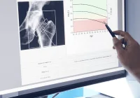 Clinician reviewing bone density scan and age-related BMD chart, indicating osteoporosis assessment and fracture risk evaluation.