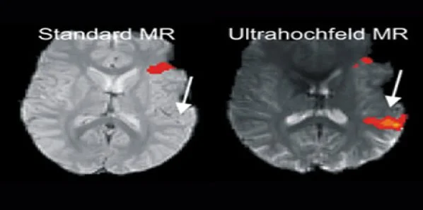 Ultra High Field MRI Pinpoints and Protects Language Centres