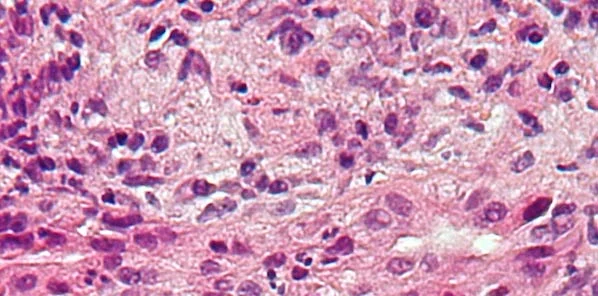 Probiotics Prevent Brain Complications of Cirrhosis