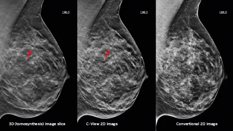 In Breast Cancer Detection, the Evidence Points to Tomosynthesis