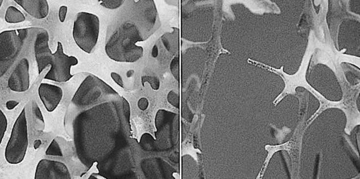 New Tool to Prevent Osteoporotic Fractures 