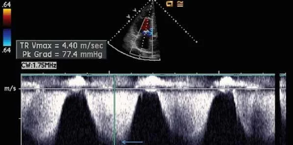 Measuring MPAP: Echocardiography Vs. Catheterisation 