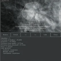 ECR2016: iCAD Unveils Tomosynthesis CAD Tool For Early Identification