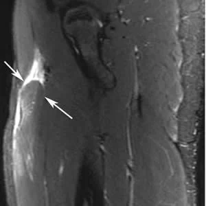 Fat-suppressed T2-weighted MR imaging demonstrates distal retraction of proximal rectus femoris muscle (arrows). 