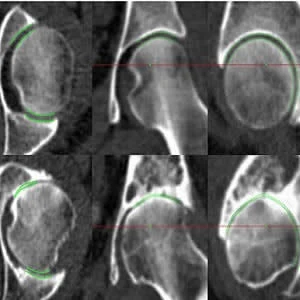 JSM performance at the extremes of disease. Joint space margins are shown in green as seen in axial, coronal and sagittal planes (left to right) at two left hips. (a) An individual with a radiographic K&L grade of 0 (no disease) and minimum joint space wi