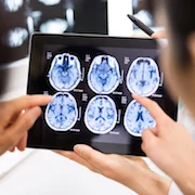 #RSNA18: MRI more accurate to predict Alzheimer’s disease