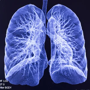 Collapsed Lung Scans: New Technology Offers Accurate Reads