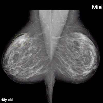 AI Solution for Breast Cancer Detection Launched 