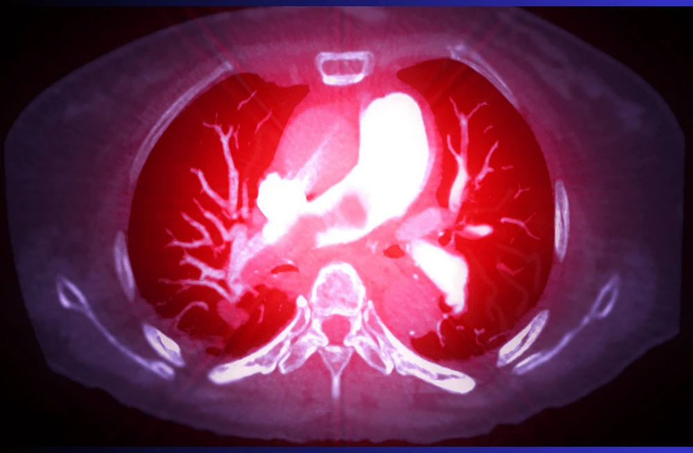 Optimising Contrast Flow Rates in CT Pulmonary Angiography
