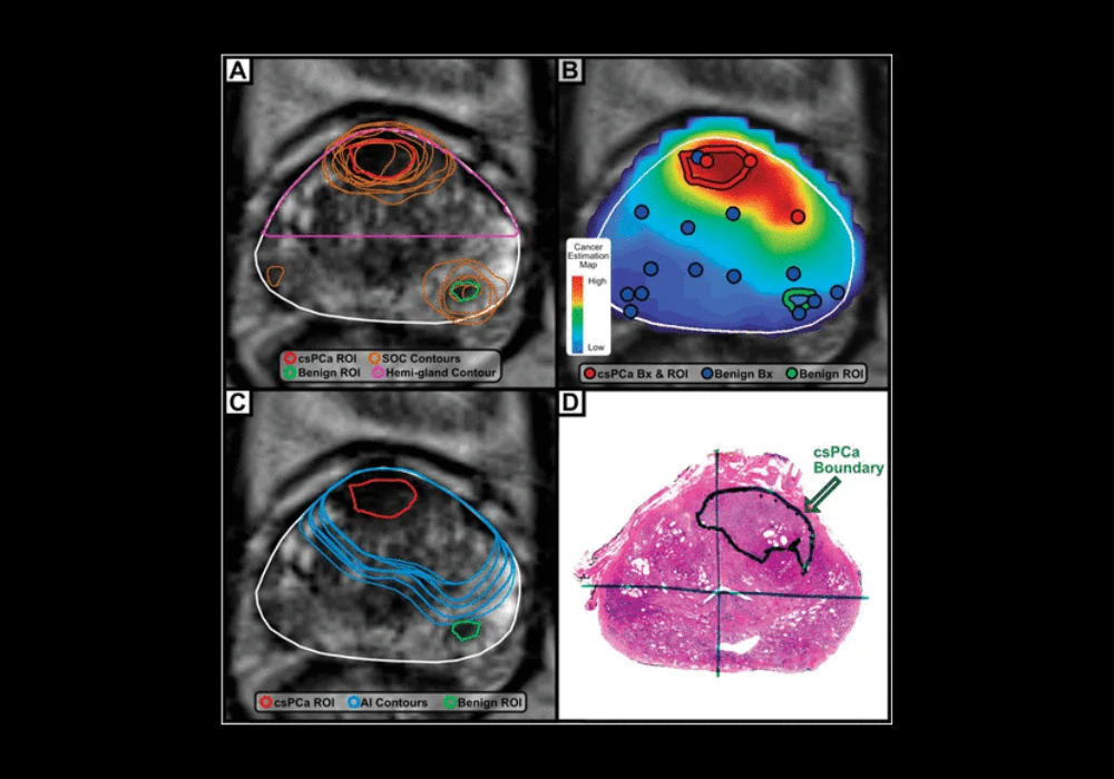 Prostate Cancer Conturing AI-Assisted Contouring in Prostate Cancer: Enhancing Accuracy ...