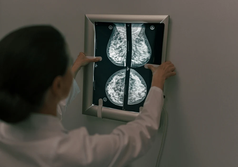 Breast Arterial Calcifications for Cardiovascular Disease Risk ...