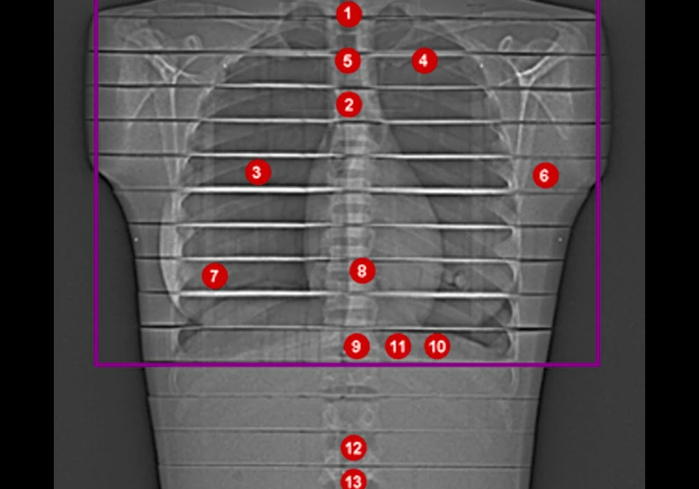 Lung Imaging: Photon-Counting Detectors & Thermoluminescence Dosimetry
