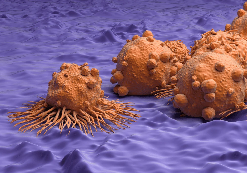 Radiomics Predict Metastasis Risk in Clear Cell Renal Cell Carcinoma