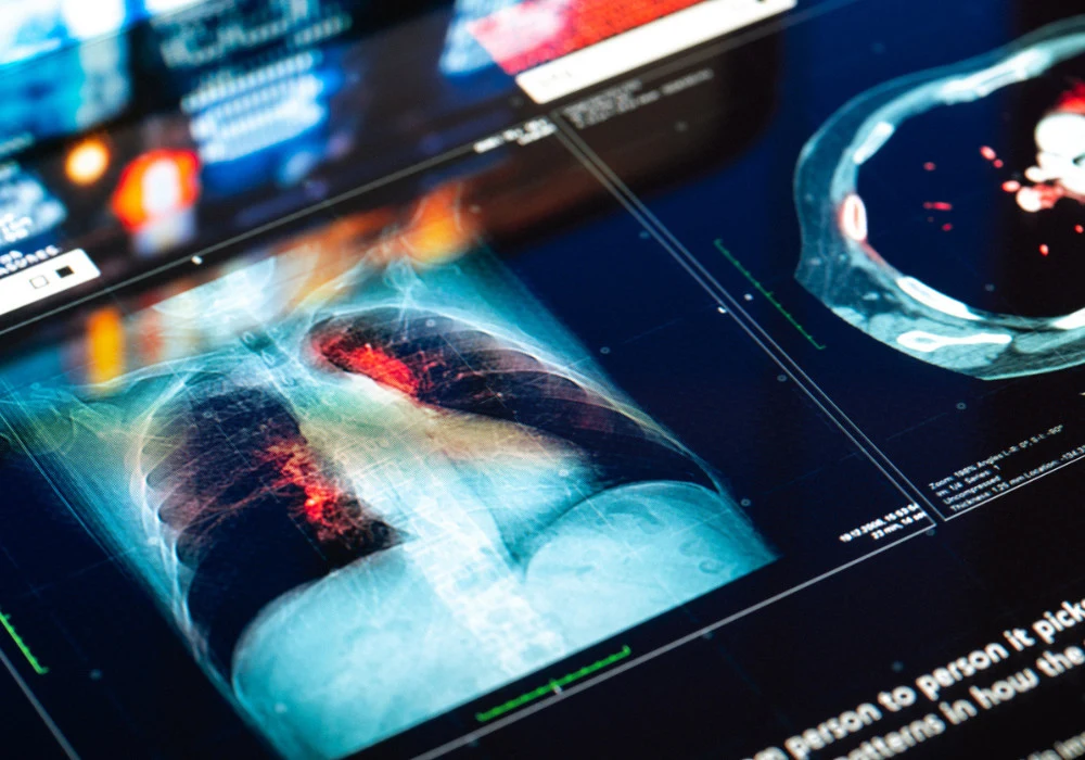 Artificial Intelligence Predicting Mortality from Chest CT Scans