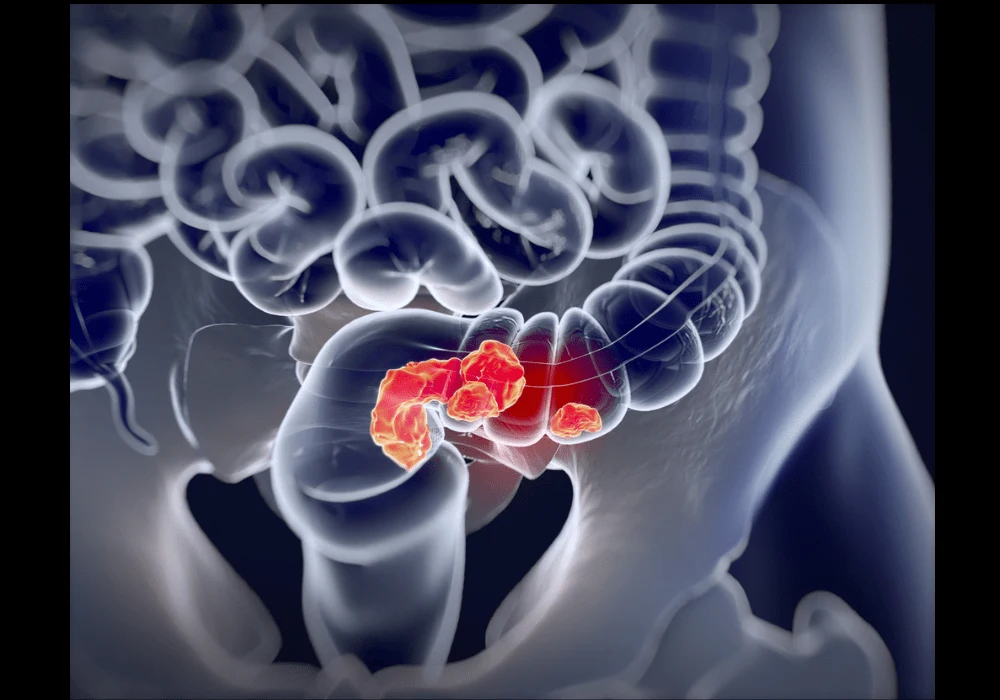 Predicting Liver Metastases of Colorectal Cancer with Radiopathomics