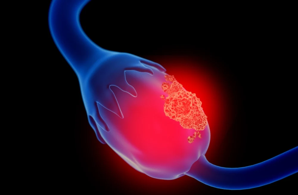 Updated Imaging Guidelines for Ovarian Cancer