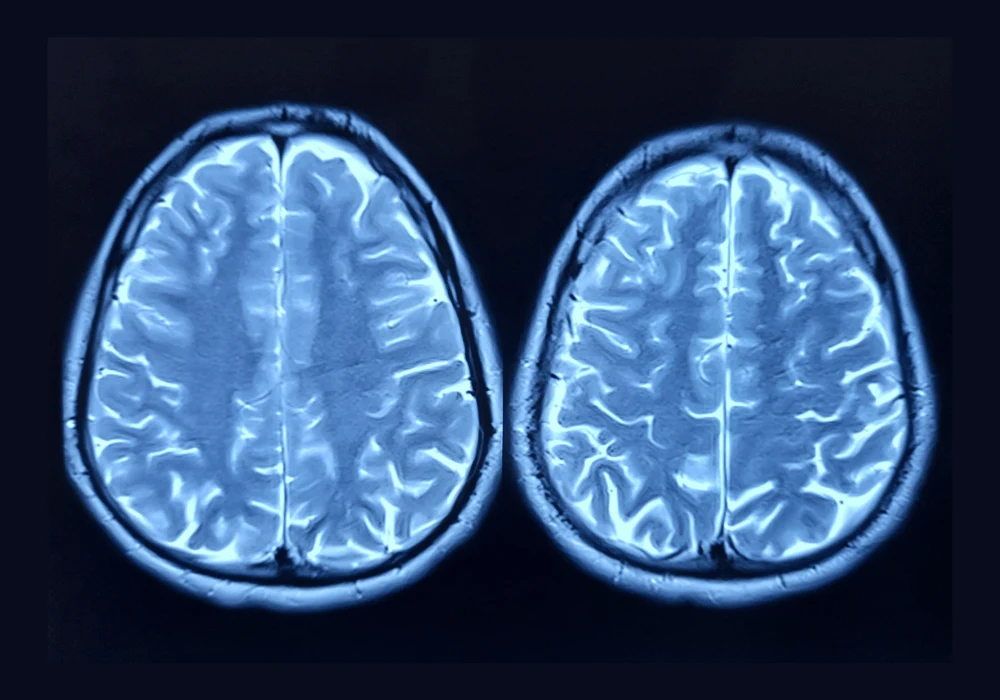 Optimising Multimodal Prompts for GPT-4V in Brain MRI Diagnosis