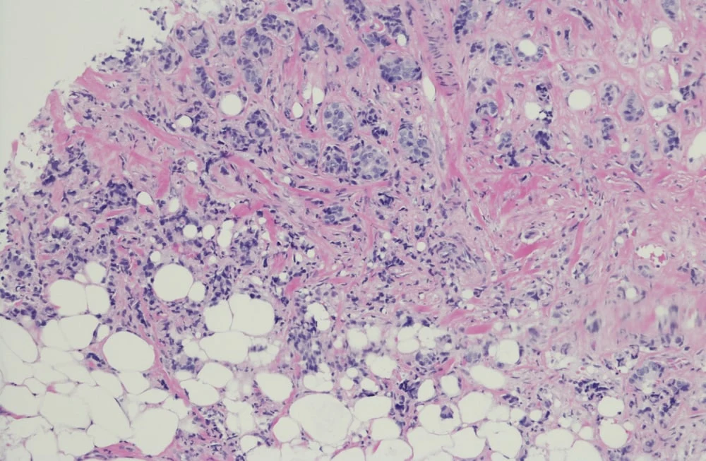 Invasive Lobular Carcinoma Detection in Breast Cancer Screening