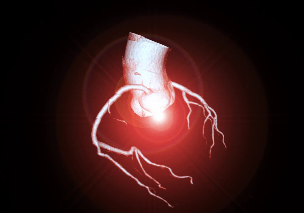 Enhanced Coronary Plaque Quantification with Ultrahigh-Resolution PCD CT