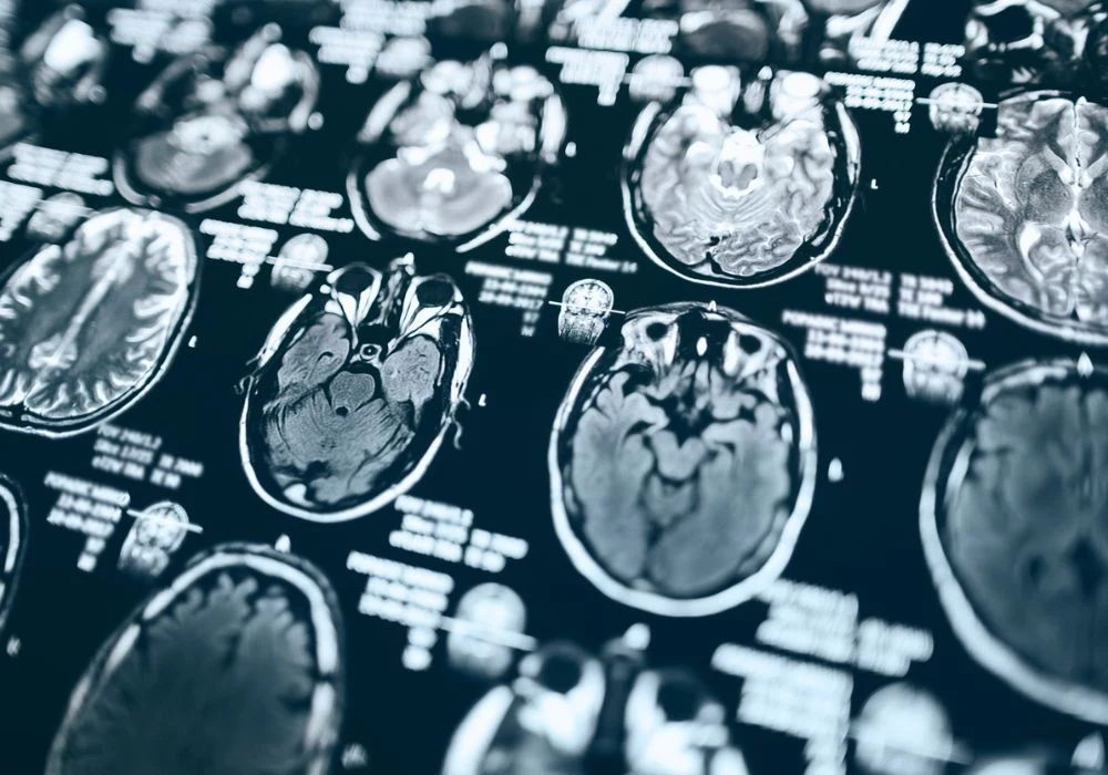 MRI brain scan results showing detailed neurological imaging for medical diagnosis 