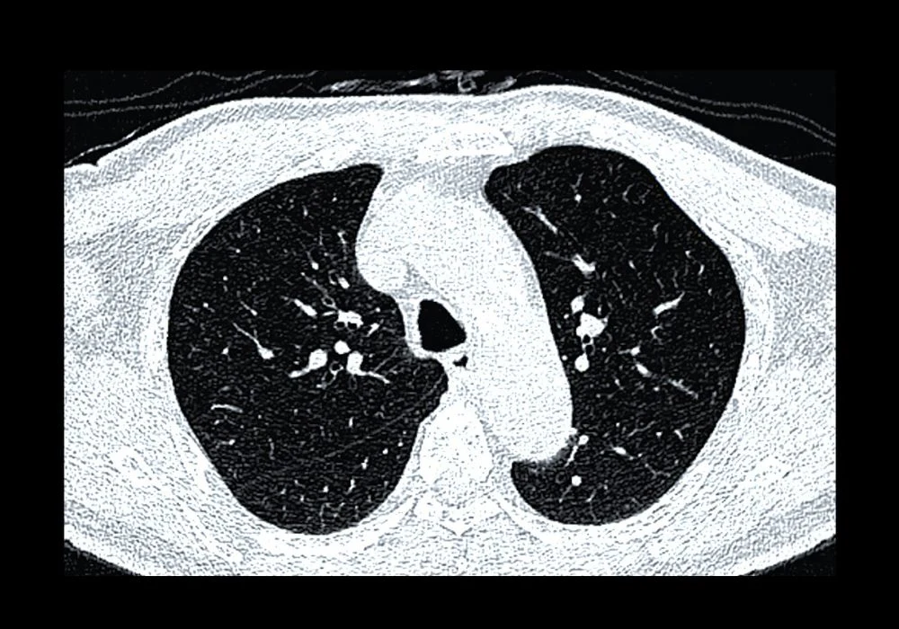 CT scan of human lungs – diagnostic imaging for lung disease, cancer, or COVID-19 evaluation