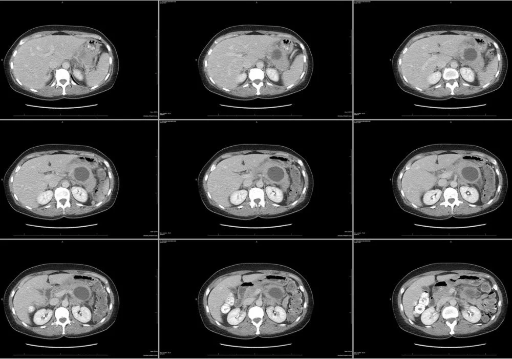 pancreatic cyst detected in CT imaging – cross-sectional abdominal scan for gastroenterology assessment 