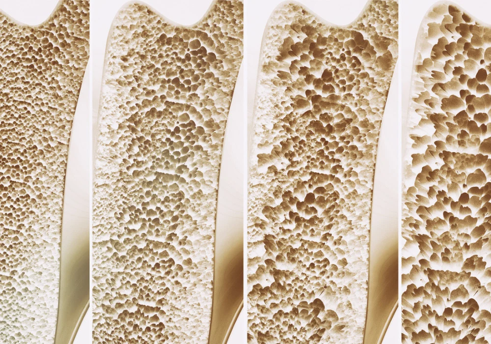 Osteoporosis progression in bone cross-section – visual comparison of healthy to porous bone structure 