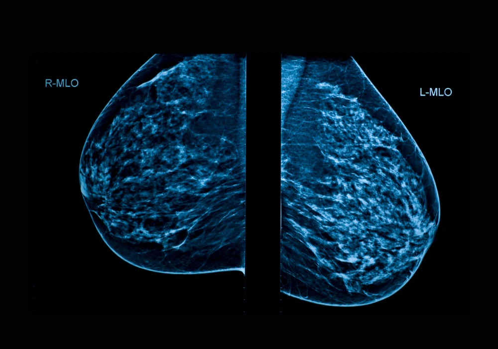 Bilateral mammogram in mediolateral oblique (MLO) view showing dense breast tissue, used for early detection of abnormalities and breast cancer screening. 