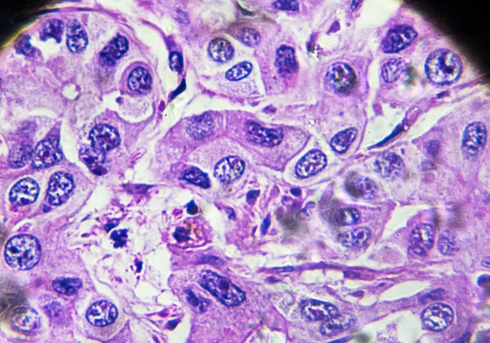 Histology slide showing cancerous cells under microscope, highlighting abnormal mitotic figures and cellular morphology used in tumour diagnosis and pathology research. 