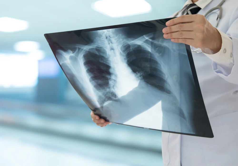 AI-Assisted Reporting in TB Chest Screening