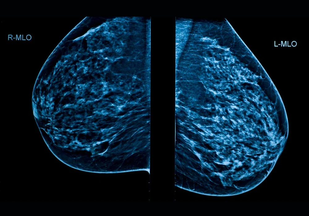 Bilateral mediolateral oblique mammogram showing dense breast tissue in a diagnostic radiology exam. 