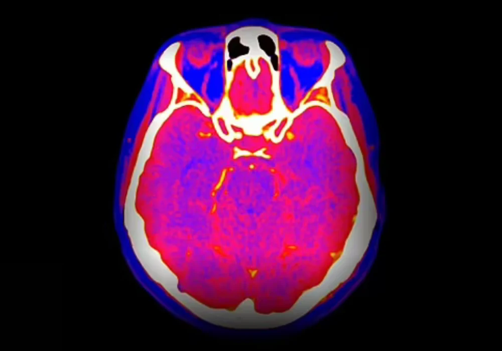 Coloured brain CT scan showing a cross-sectional view of the head, used for neurological assessment and diagnostic imaging. 
