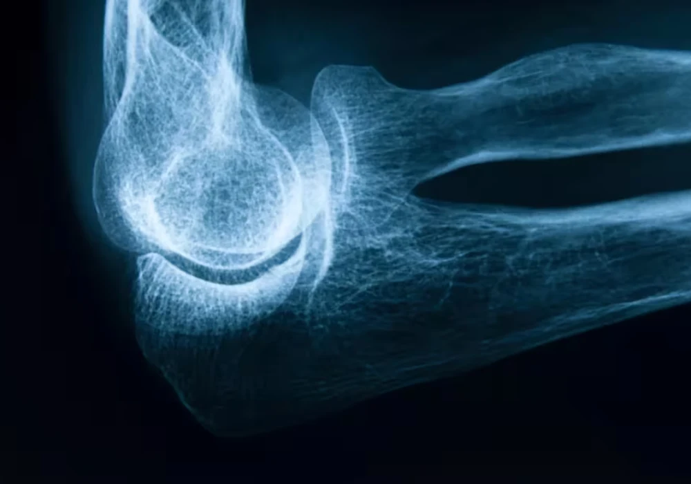 Lateral elbow X-ray showing humerus, radius and ulna for trauma assessment