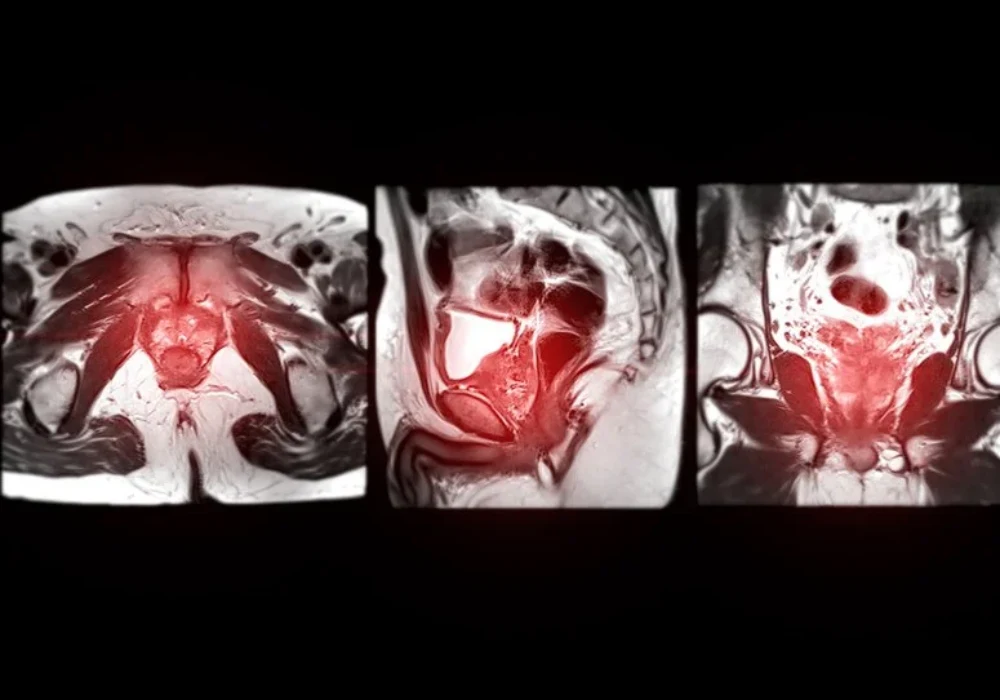 MRI images highlighting pelvic anatomy with marked area of inflammation for clinical evaluation.