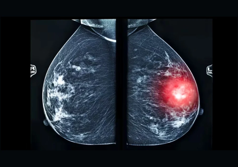 Medical illustration highlighting breast abnormalities, illustrating diagnostic imaging and breast cancer detection.