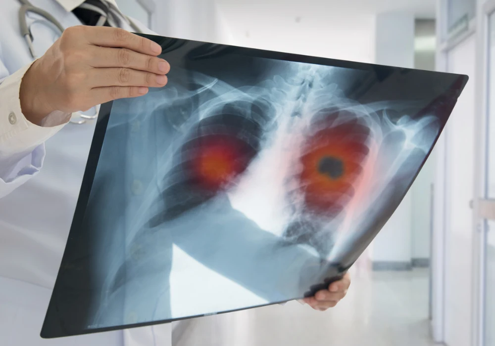 Doctor reviewing a chest X-ray with highlighted lung abnormalities, supporting pulmonary diagnosis, radiology assessment and respiratory care.
