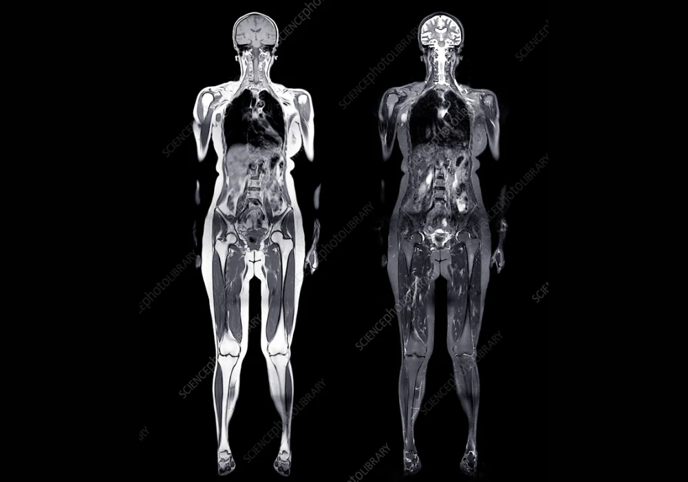 Whole-body MRI scan showing coronal views, supporting radiology assessment, disease detection, oncology staging and precision care planning.