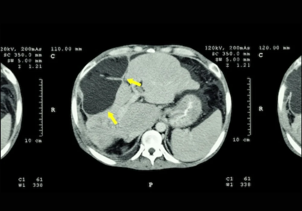 Abdominal CT scan showing a liver lesion, supporting hepatology assessment, oncology imaging, diagnostic evaluation and treatment planning.