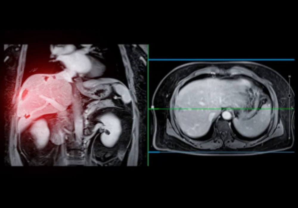 Abdominal MRI scan with highlighted liver area, supporting hepatic lesion assessment, radiology diagnosis and hepatology care planning.