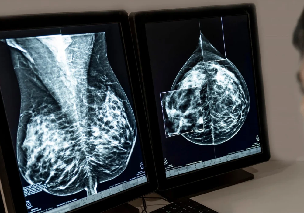 Breast ultrasound images with highlighted lesion, supporting breast cancer diagnosis, radiology assessment and women’s health screening.