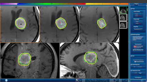 Preoperative planning software / neurosurgery / medical M?Vision™ Monteris Medical Preoperative planning software / neurosurgery / medical M?Vision™ Monteris Medical