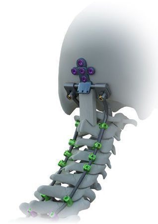 Occipito-cervico-thoracic spinal osteosynthesis unit / posterior AVALON™ Alphatec Spine