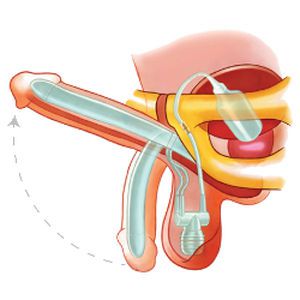 Inflatable penile prosthesis ZSI 475 Zephyr Surgical Implants Inflatable penile prosthesis ZSI 475 Zephyr Surgical Implants