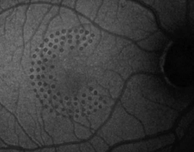 Health Management and Leadership Portal Retinal photocoagulation